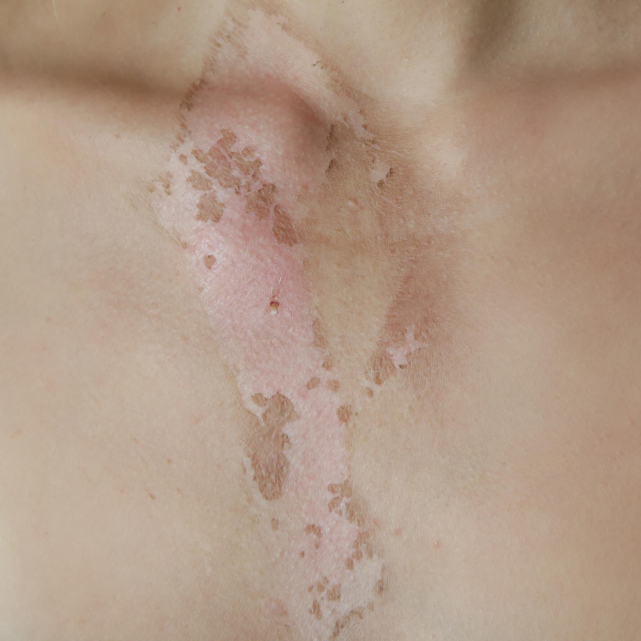 Queimadura de primeiro grau